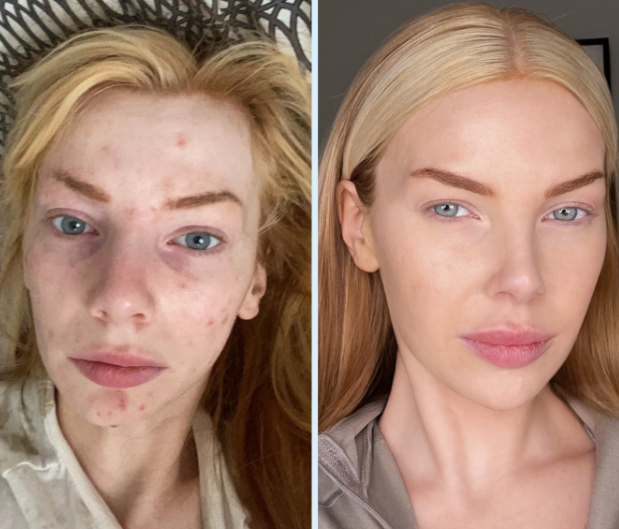 Blume skincare routine with Milky Fade Serum, Meltdown Gel Cream, and Meltdown Acne Oil